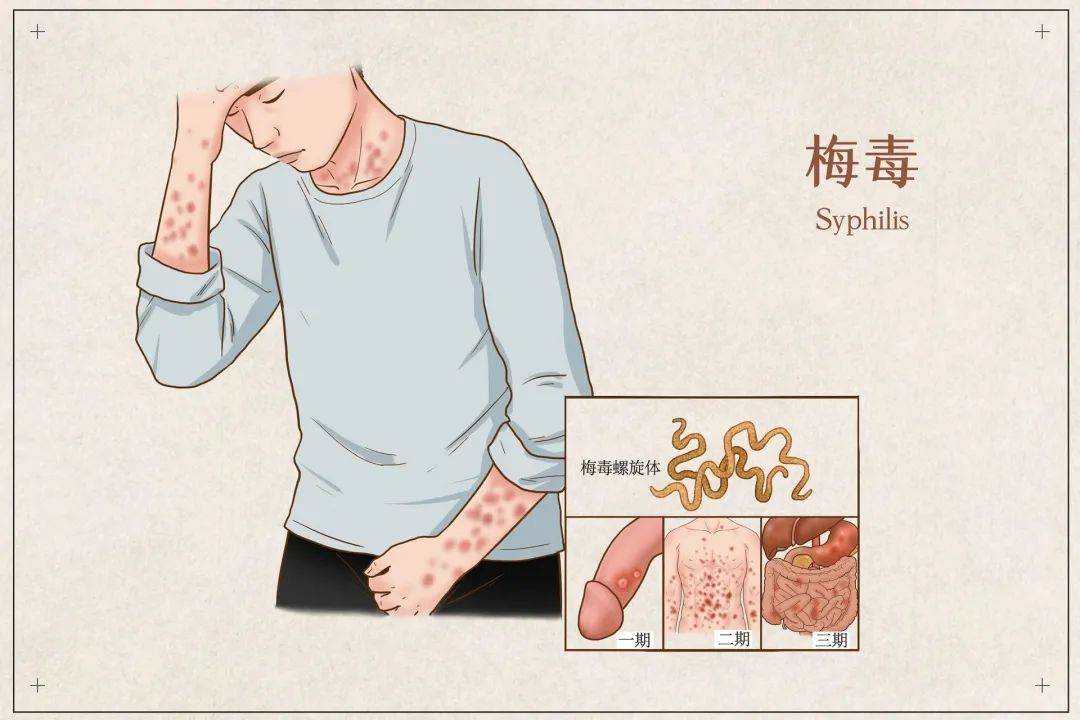 了解性传播疾病才能针对性做好预防工作